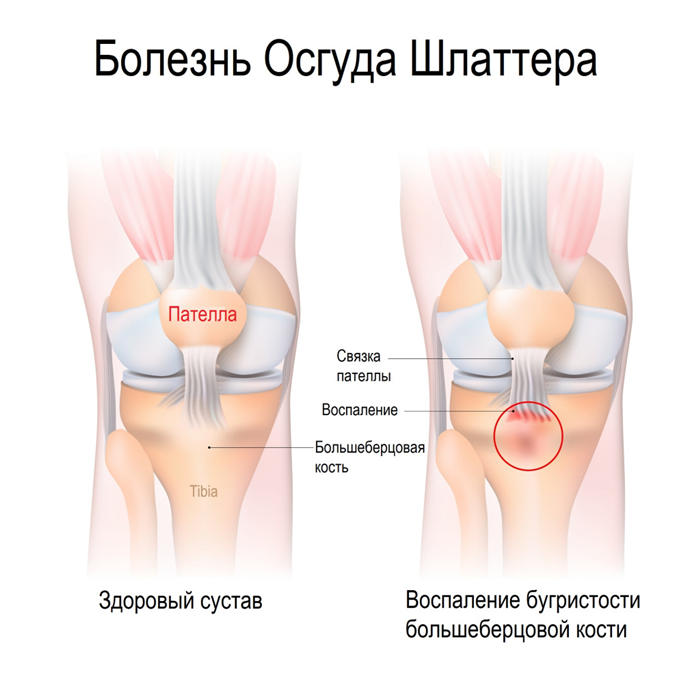 Причины возникновения и развития остеохондропатии бугристости большеберцовой кости